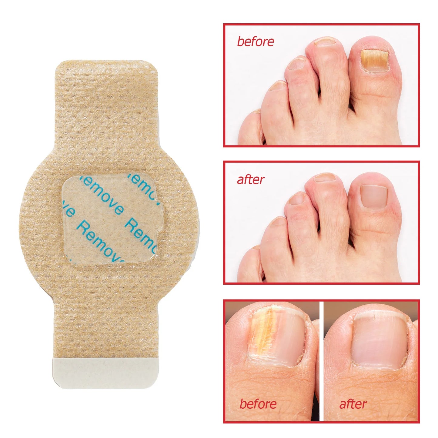 Fungal Nail Repair Patches™ – Restore Healthy Nails Overnight
